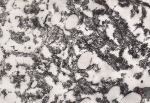 F,33y. | "ground glass" hepatocyte … filamentous inclusions ofhepatitis B surface antigen(HBsA) F,33y. | "ground glass" hepatocyte … filamentous inclusions ofhepatitis B surface antigen(HBsA)